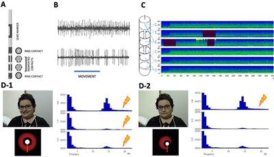 Non-motor Adverse Effects Avoided by Directional Stimulation in Parkinson's Disease: A Case Report